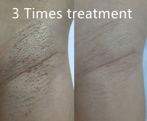 อุปกรณ์กำจัดขนด้วยเลเซอร์ไดโอดอเนกประสงค์ รองรับความกว้างพัลส์ที่แตกต่างกัน เพื่อการลดขนอย่างถาวรที่ปรับแต่งได้