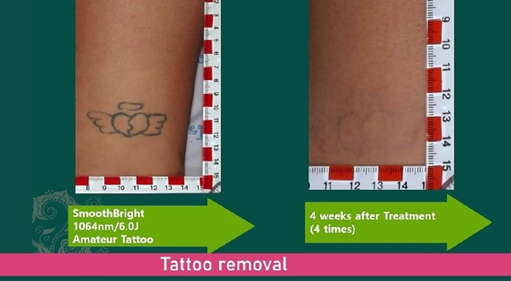 1064nm Q Switched Nd Yag Laser Picosecond เครื่องกําจัดรอยสัก