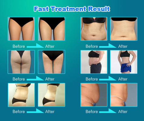 5 ใน 1 เครื่องลดน้ําหนัก Vela, เครื่องลดเซลลูไลท์ Velashape สําหรับหน้า / ร่างกาย