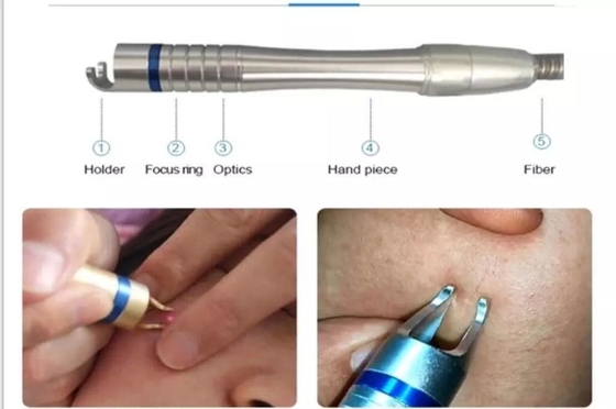 เครื่องกําจัดหลอดเลือดด้วยเลเซอร์ 15W 30W สําหรับการรักษาเล็บเท้า / การเยียวยาผิวหนังด้วยเลเซอร์ร้อน