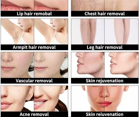 4 ใน 1 เครื่องทําความงามหลายฟังก์ชัน เครื่องกําจัดรอยสักเลเซอร์ความยาวคลื่นสาม